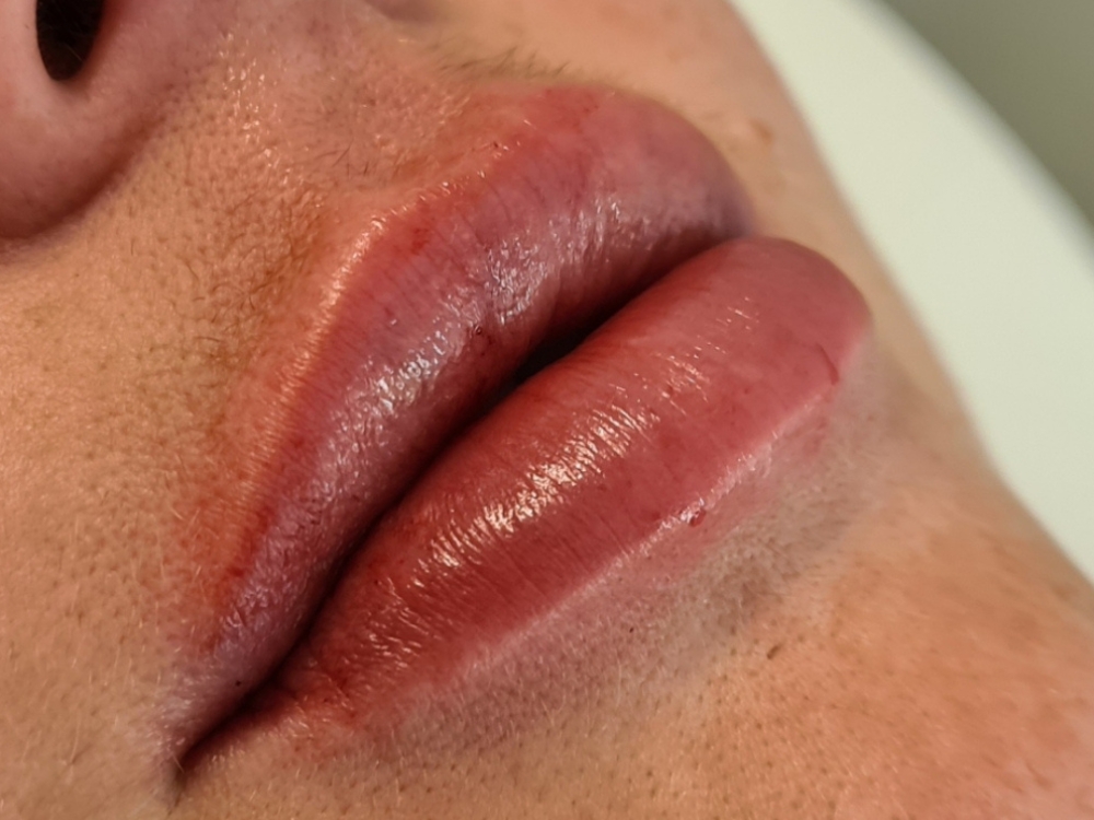 Close-up view of lips following a medical aesthetics treatment