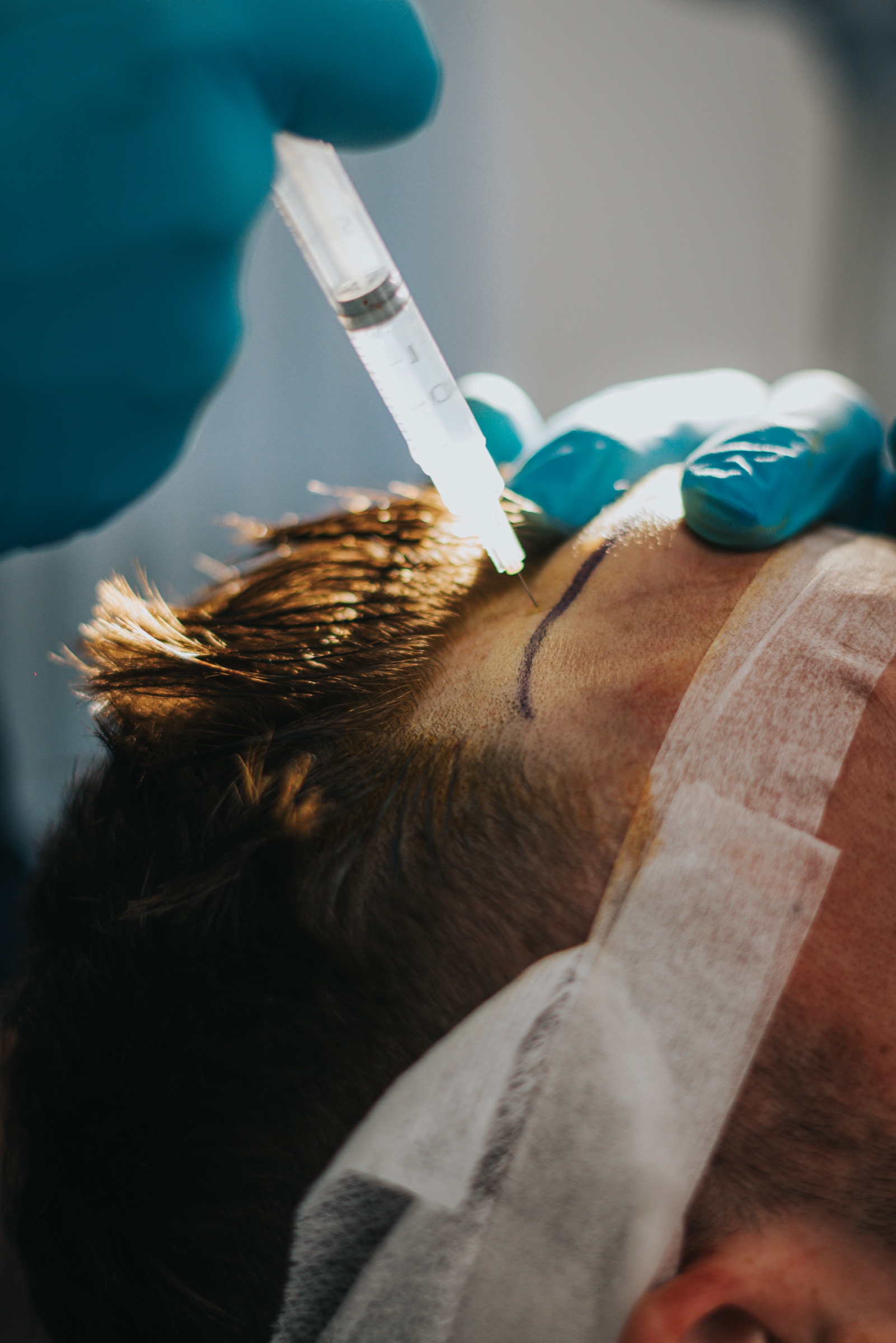 Local anaesthetic being administered before an FUE hair transplant procedure