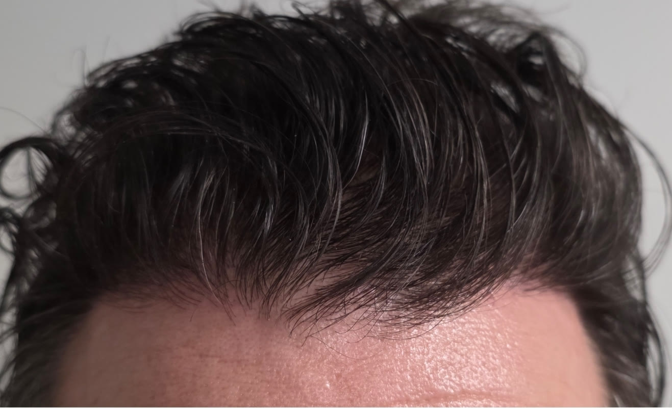 Patient after an aesthetic treatment