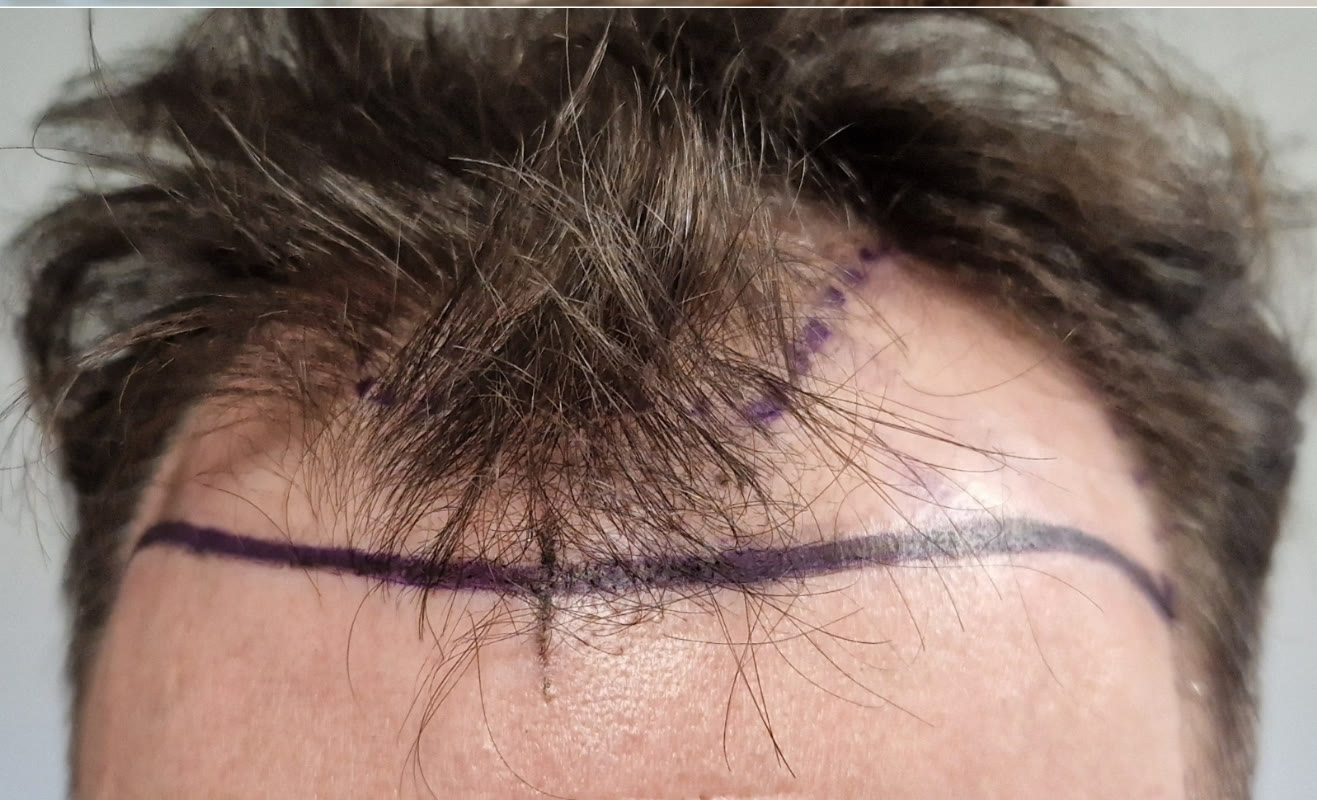 Patient before an aesthetic treatment